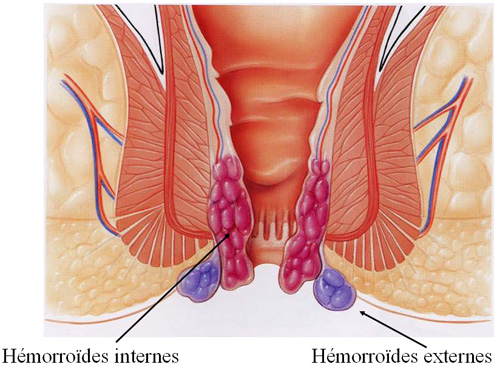 Qu'est-ce qu'une hémorroïde ? Chirurgie Viscérale à Montpellier