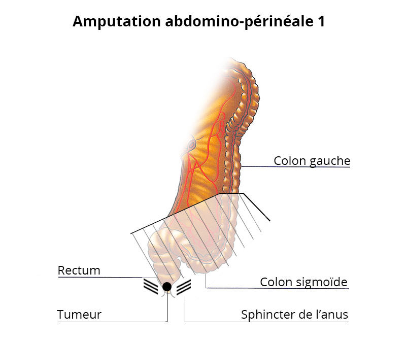 amputation_abdomino-perineale1