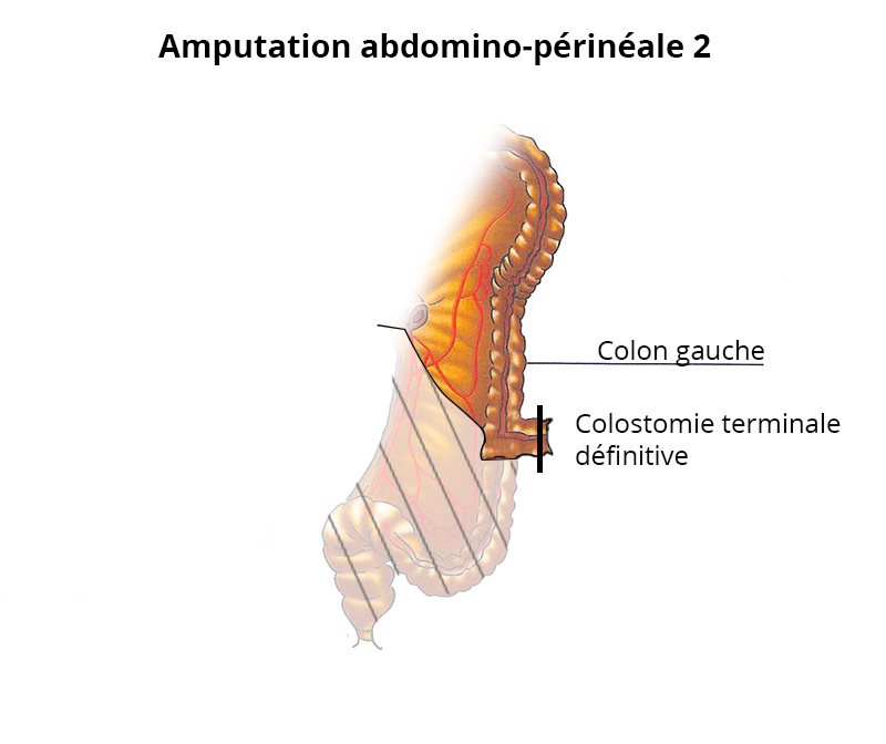 amputation_abdomino-perineale2