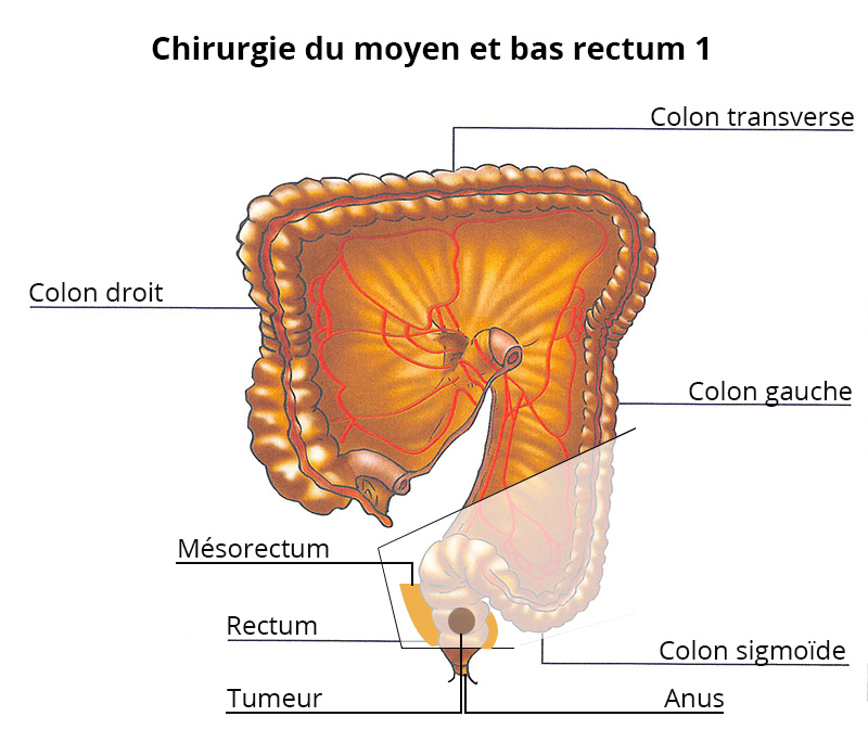 chirurgie-du-moyen_bas_rectum1