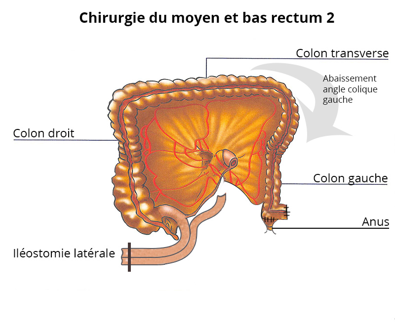 chirurgie_moyen_bas_rectum