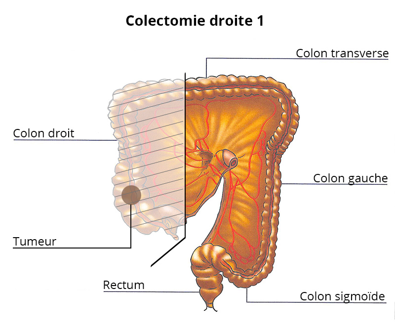 colectomie_droite1