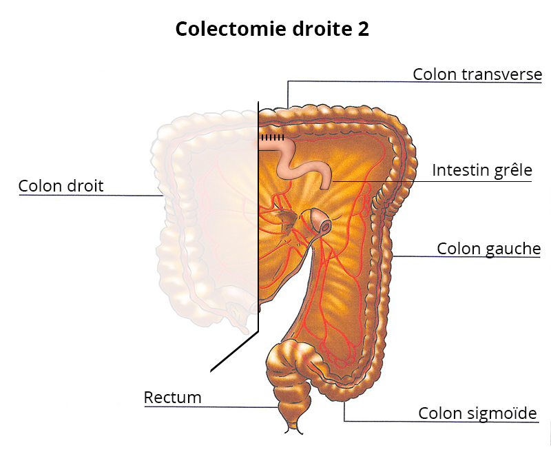 colectomie_droite2