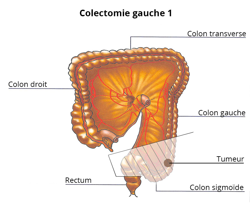 Chirurgie du colon à Montpellier - Chirurgie Digestive