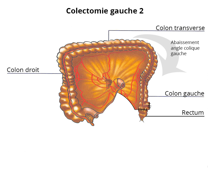 colectomie_gauche2