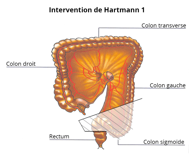 intervention_hartmann1