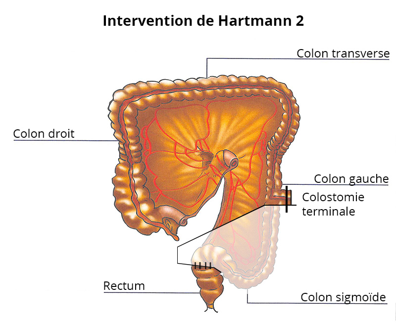 intervention_hartmann2