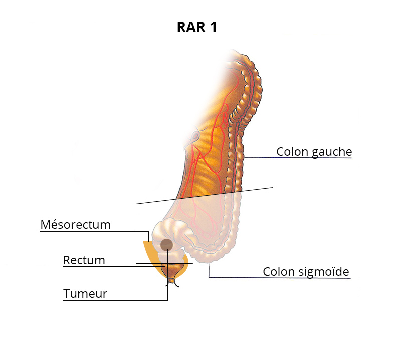 rar1