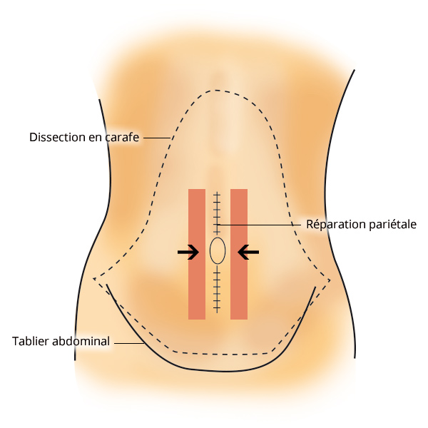 dermolipectomie