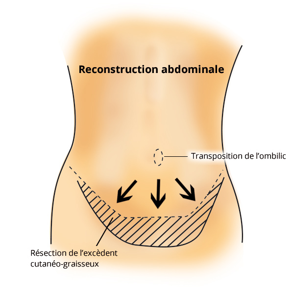 dermolipectomie2