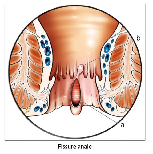 Fissure anale à Montpellier - Chirurgie Viscérale