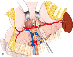 pancreatectomie