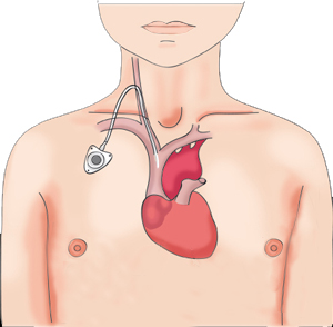 chambre_implantable