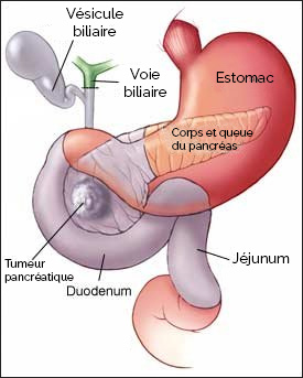 Duodénopancréatectomie céphalique : ablation