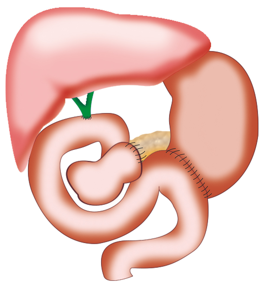 Duodénopancréatectomie céphalique : reconstruction.