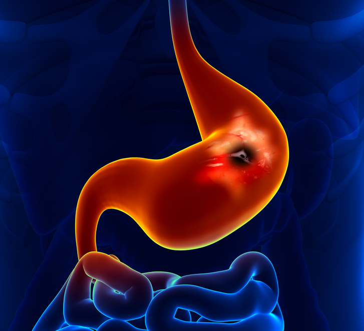 Peptic Ulcer - Stomach problem