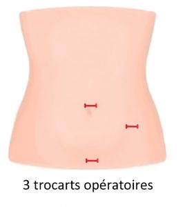 Chirurgie de l'appendice à Montpellier - Chirurgie digestive