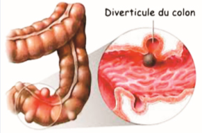 Sigmoïdite à Montpellier - Chirurgien digestif à Castlenau