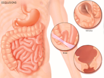 Occlusion intestinale à Montpellier - Chirurgien digestif