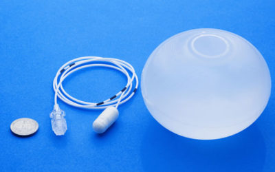 Perdre du poids sans chirurgie avec le ballon gastrique