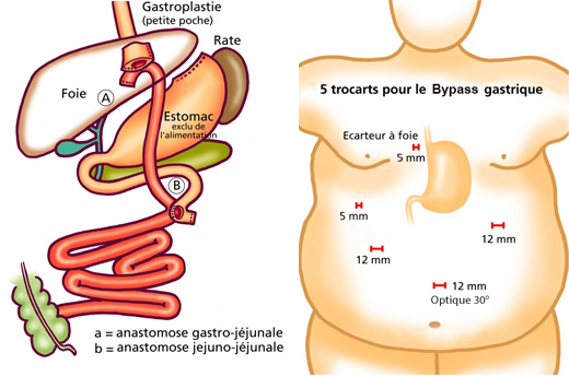 UPSOM - Bypass Gastrique Centre de Chirurgie Viscérale et de l ...