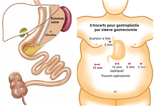 UPSOM - Sleeve gastrectomie Centre de Chirurgie Viscérale et de l'Obésité  Montpellier