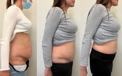 Abdominoplastie après chirurgie bariatrique