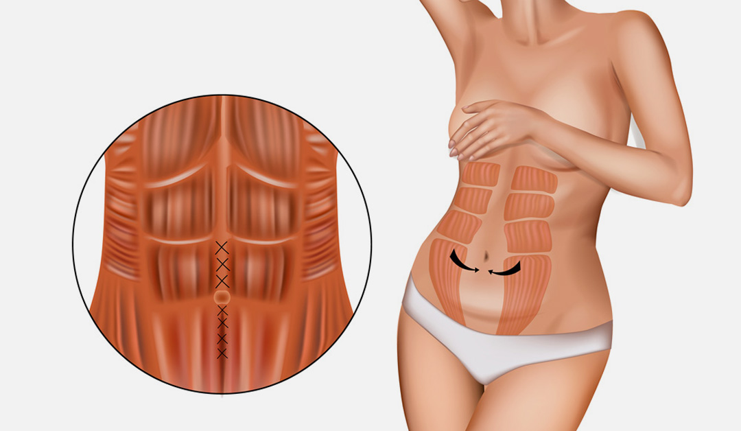 Cure de diastasis : des cicatrices très discrètes grâce à des techniques mini-invasives